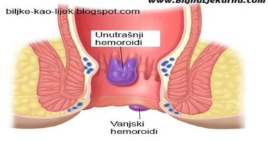 hemoroidi Biljna Ljekarna
